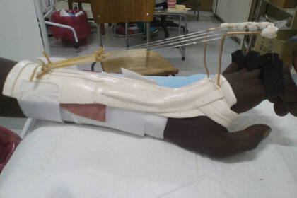Ergotherapie in Namibia: Geschienter Arm